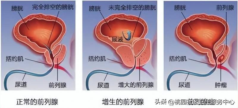 人口与健康，关注男性健康，提升生命质量