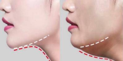 面部吸脂改善面部松弛下垂原理一，紧致肌肤新途径