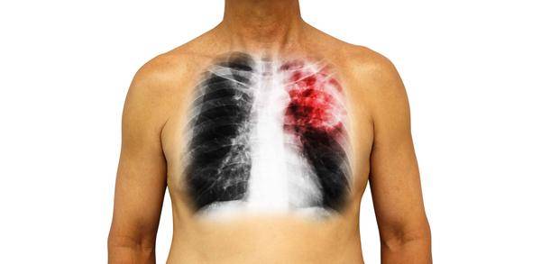 “肺炎的种类，了解这8种类型，精准治疗助缓解”