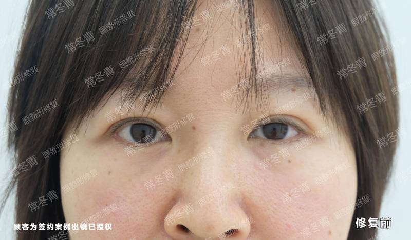 天津双眼皮修复技术好的医生，改善不对称重获美眸