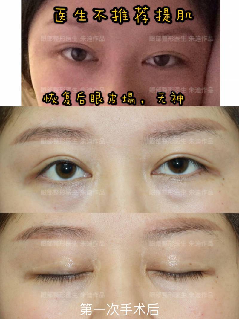 技术可靠的上海双眼皮修复医生测评，真实经历分享，重拾美丽
