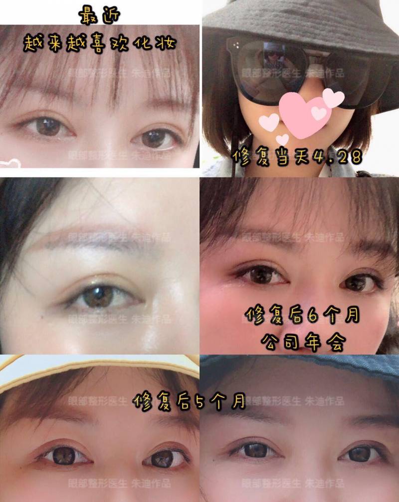 技术可靠的上海双眼皮修复医生测评，真实经历分享，重拾美丽