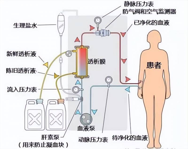 透析的作用原理与血液净化的关联