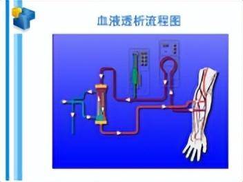 透析的作用原理与血液净化的关联