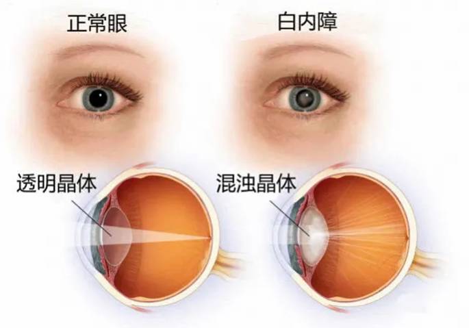 人工晶体植入眼内，白内障手术的必要选择