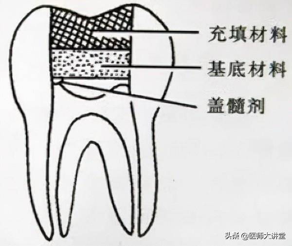 超根尖孔拔髓针取出实例，45岁男性牙髓炎治疗分享