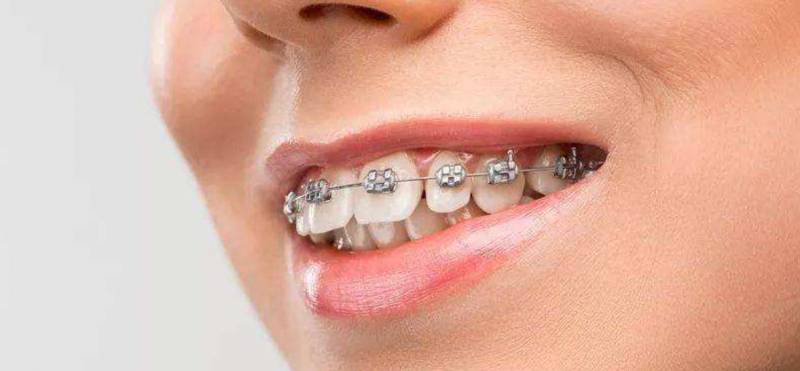 固定牙套有几种类型，各有哪些特点？