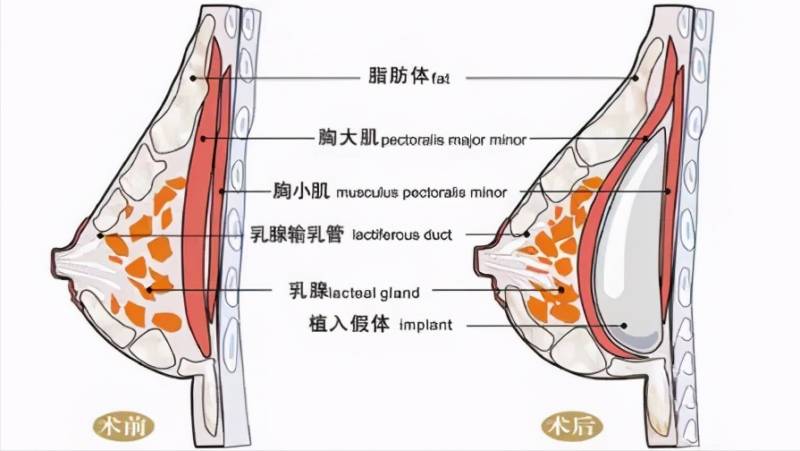 怎么做隆胸手术？隆胸后的哺乳问题详解