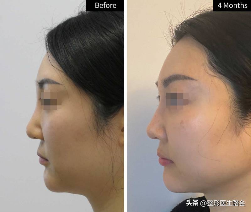 国内鼻修复大咖测评分享，36岁京漂鼻修复历程，4个月弯路总结