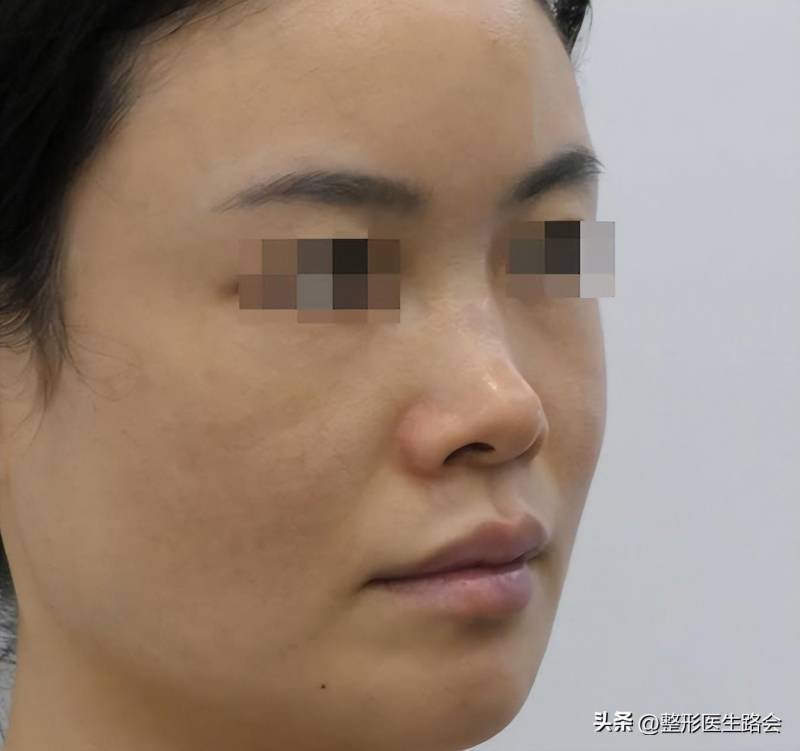 北京隆鼻体验分享，30岁姑娘全膨体隆鼻，75天焕然一新