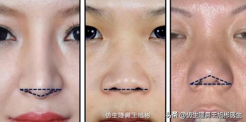 这是一个典型的亚洲短鼻延长手术，如何定义短鼻，延长后变化？