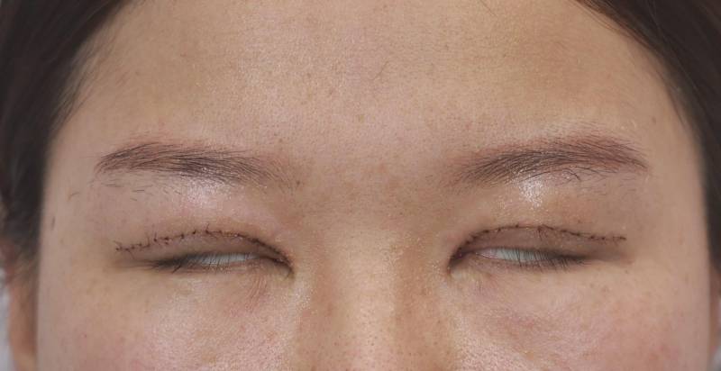 双眼皮术后必经的五个阶段，恢复与护理要点