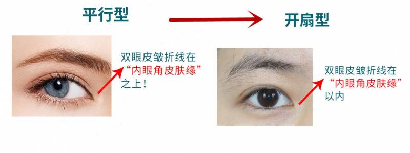 大连双眼皮修复推荐，河南姑娘不满意重修，3个月后变美经历