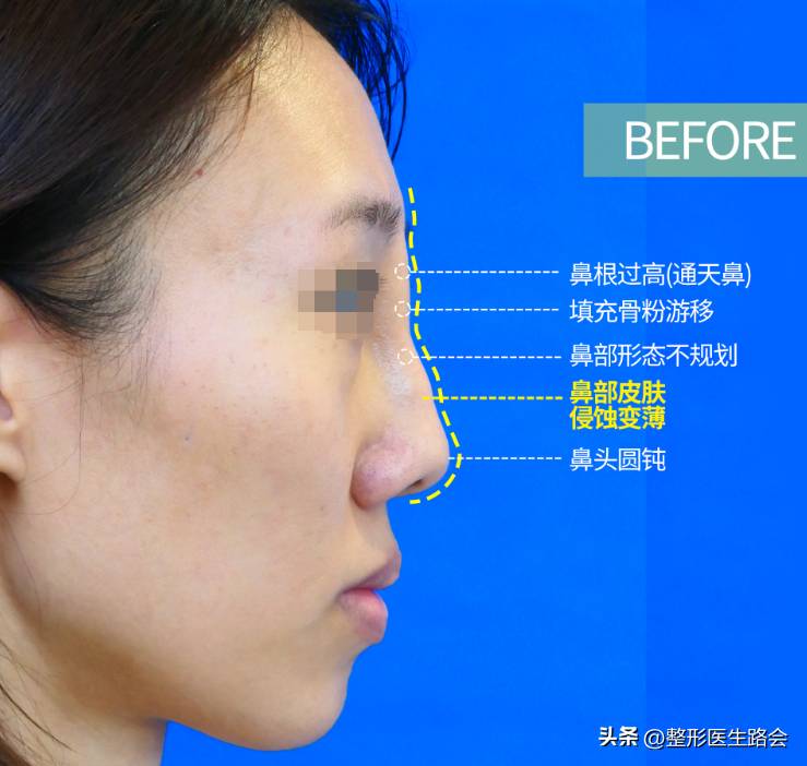 北京隆鼻專家北京鼻脩複厲害毉生，29嵗脩複骨粉隆鼻，重塑完美鼻型