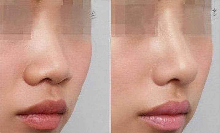 隆鼻修复最多可以做几次，如何避免过度修复？