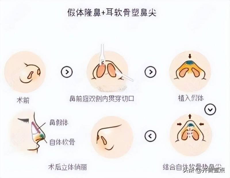 哪里的隆鼻手术好——杭州华美整形分享，隆鼻最佳恢复时机