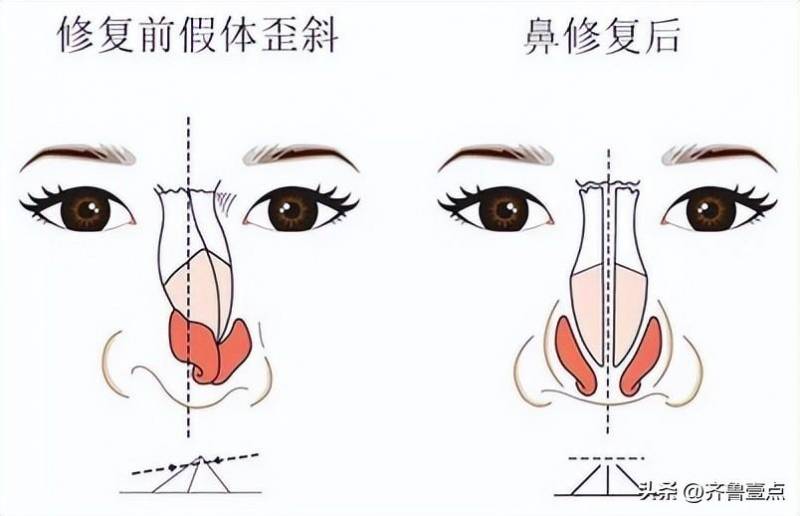 隆鼻哪家整形医院好？专业推荐与术后恢复技巧