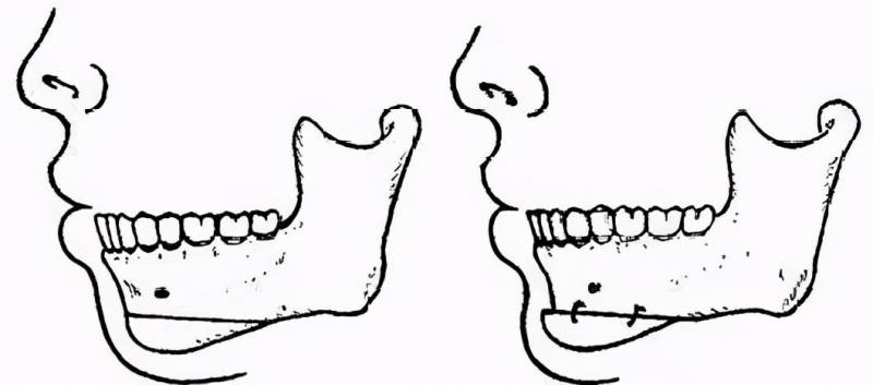 「整形知识」颏成型与假体下巴的区别解析？同学们想了解的这里都有！