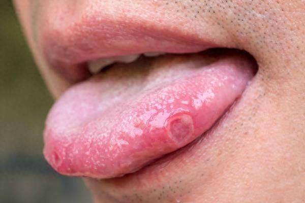 舌头溃疡怎么办？专家，注意这些症状，及时就医！