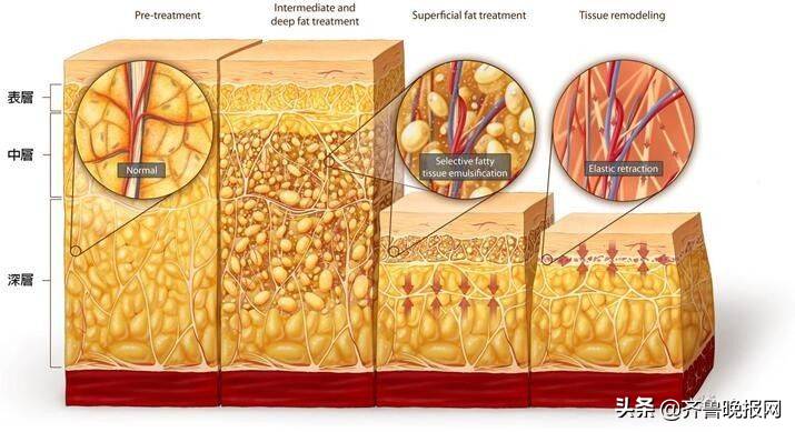 八大处整形杨庆华解析深浅层脂肪在整形中的作用
