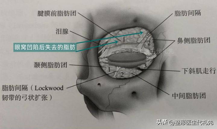 眼窝凹陷应该怎么办？原因、恢复与解决方法全面解析