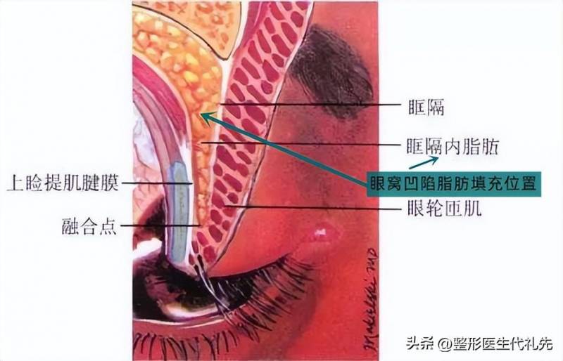 眼窝凹陷应该怎么办？原因、恢复与解决方法全面解析