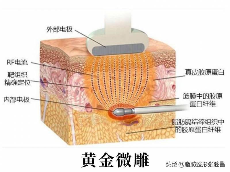 吸脂仪器怎么选？别随便乱做“吸脂”！选错了吸脂方式，效果很容易不理想。