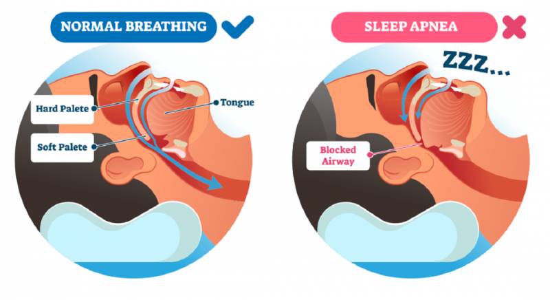 CPAP睡眠呼吸機，改善打鼾與睡眠呼吸暫停