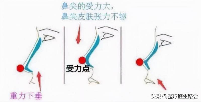 硅胶隆鼻效果与风险分析，是否永久以及潜在危害