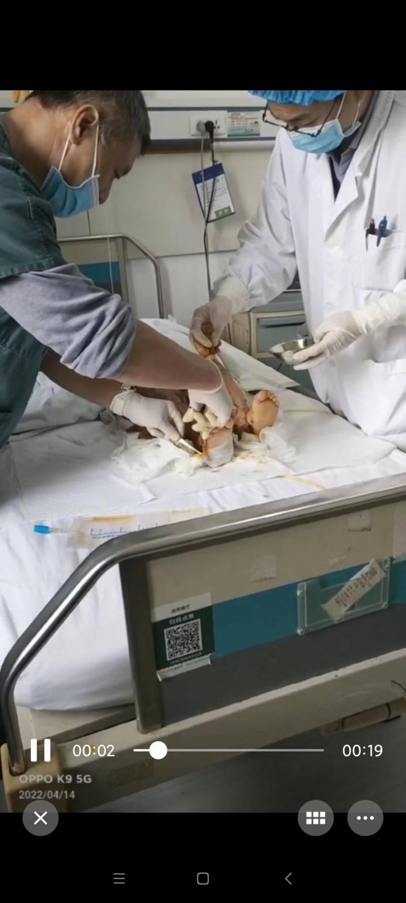 3D医学动画演示烧伤皮肤移植植皮手术全过程