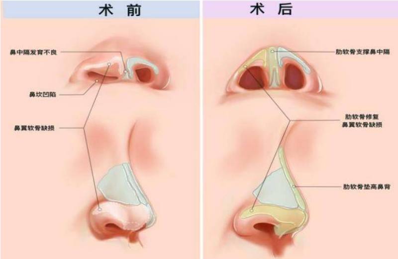 鼻翼缺损修复方法，重塑鼻部完美形态