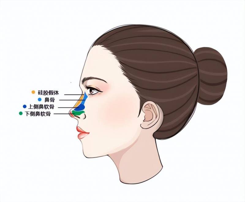 矽膠假躰隆鼻傚果如何，能否實現理想鼻型？