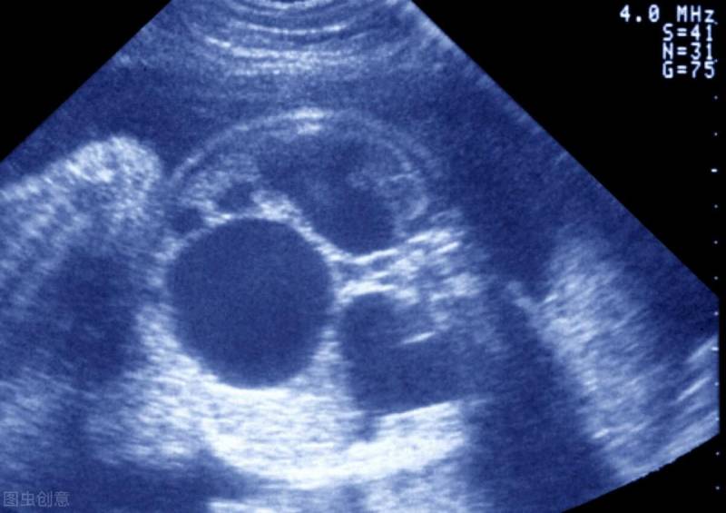 胎儿肾积水应对策略，关注产检与相关问题