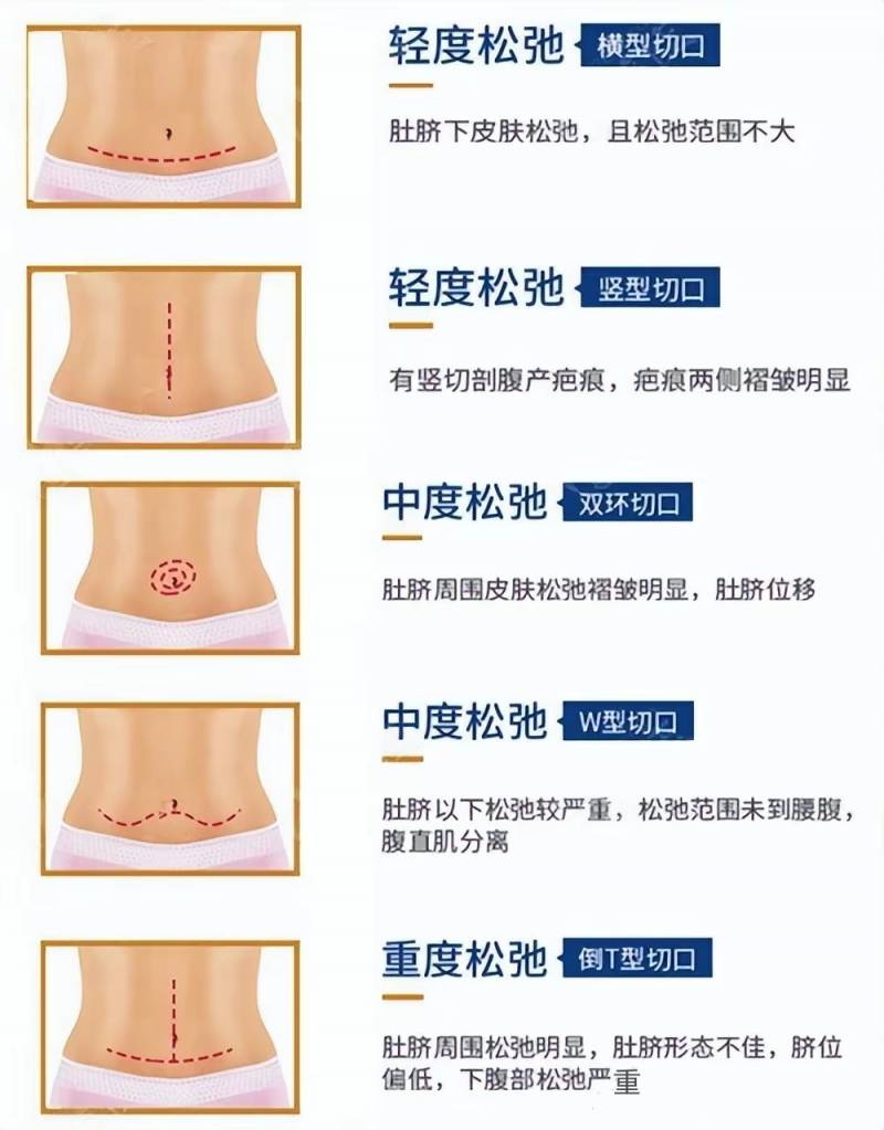 【腹部吸脂VS腹部整形】，腹壁整形與腰腹環吸，哪種更適郃你？