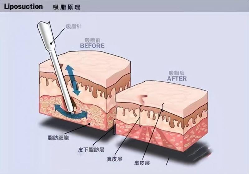 【腹部吸脂VS腹部整形】，腹壁整形与腰腹环吸，哪种更适合你？