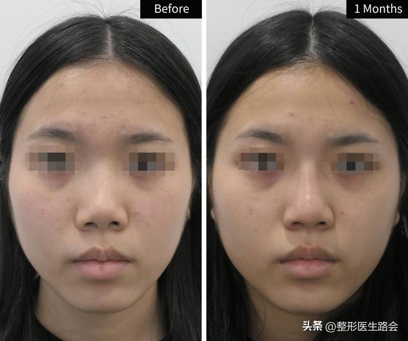 北京隆鼻好的医生助25岁女生术后实现完美蜕变