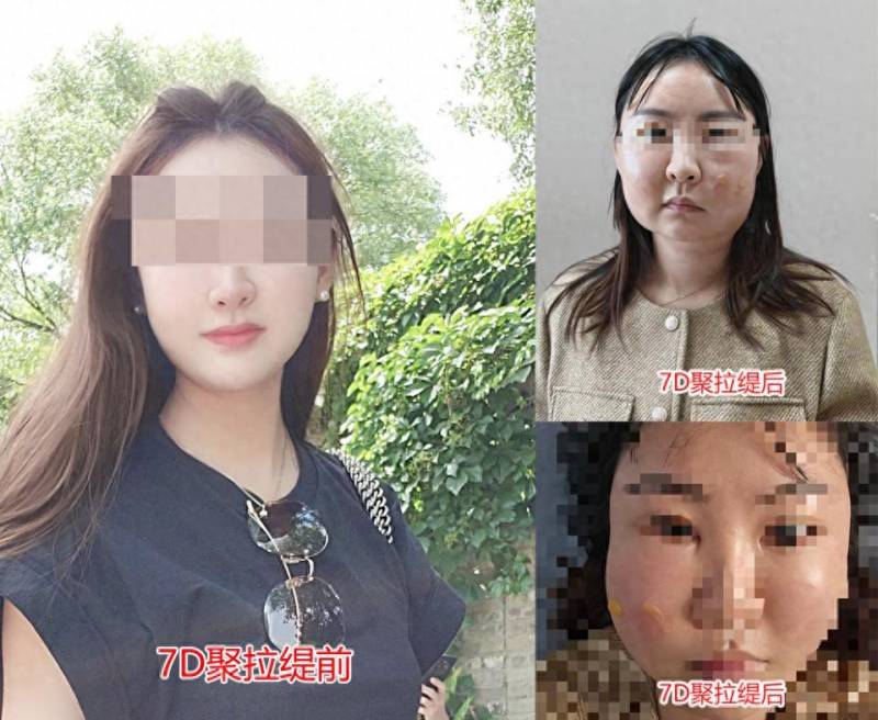 女子在郑州一医院整形，术后感染引发纠纷