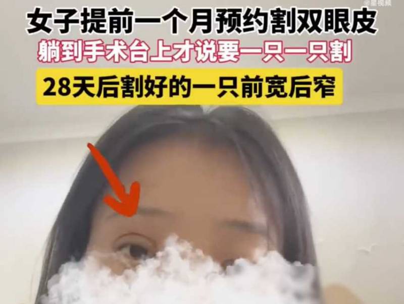 女子割双眼皮后悲剧，一只眼睛变美，另一只却仍原样