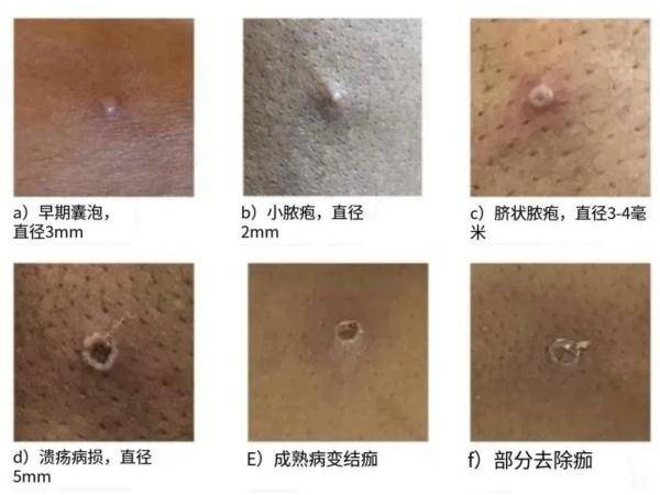 普通人如何预防猴痘？了解病毒传播途径和预防措施是关键→