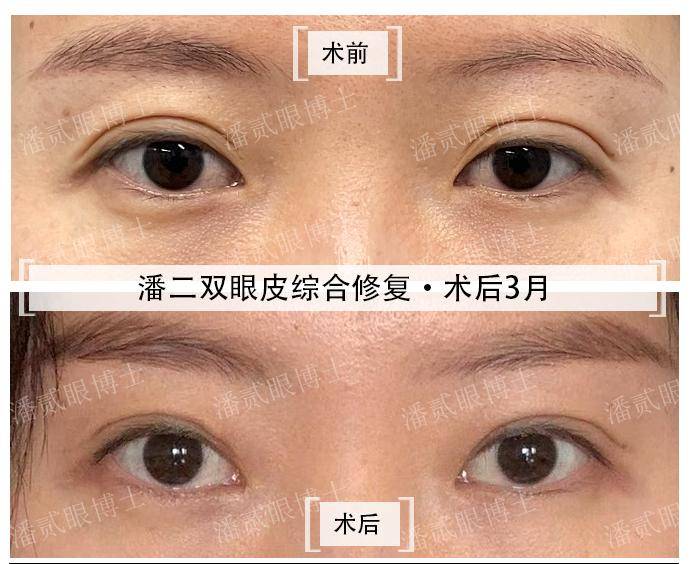 深圳双眼皮医生测评，揭秘双眼皮修复中的关键细节