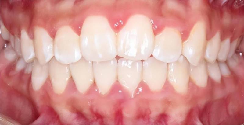 明星的牙爲什麽那麽白，與普通人牙齒顔色差異的原因分析