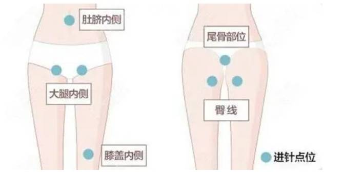 吸脂塑形减脂塑形，专家详解与体重减轻的区别