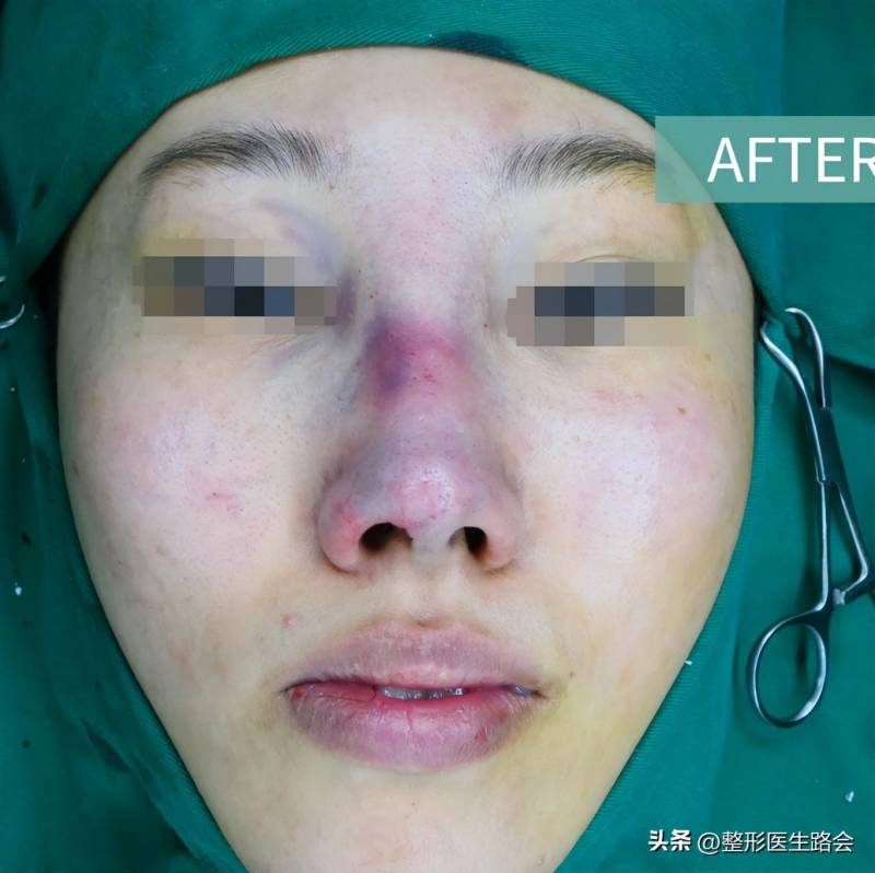 北京隆鼻专家盘点，骨粉隆鼻修复成功案例分享