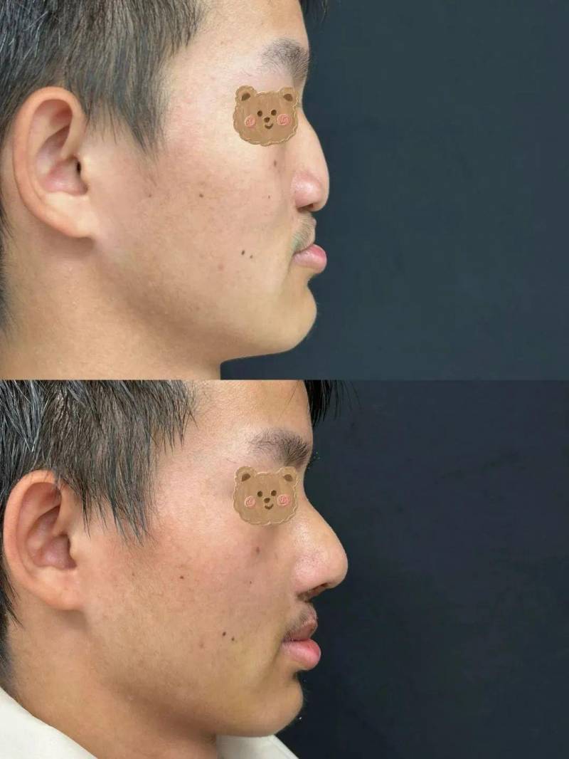 全国鼻修复专家测评分享，19岁小伙在华西完成高难度鼻唇修复