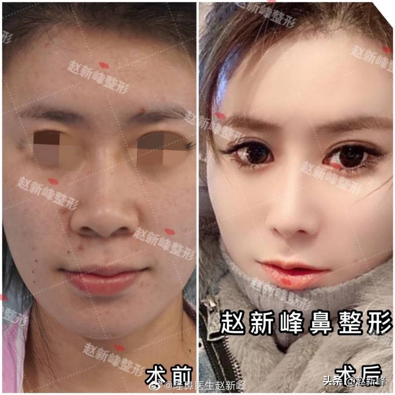 北京隆鼻整形医院医生推荐，她在大鼻头困扰下找到赵院，实现完美蜕变！