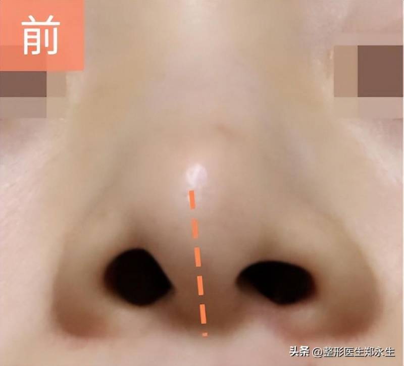 鼻翼两侧不对称？探究鼻子整形后鼻孔不对称的原因与解决之道！