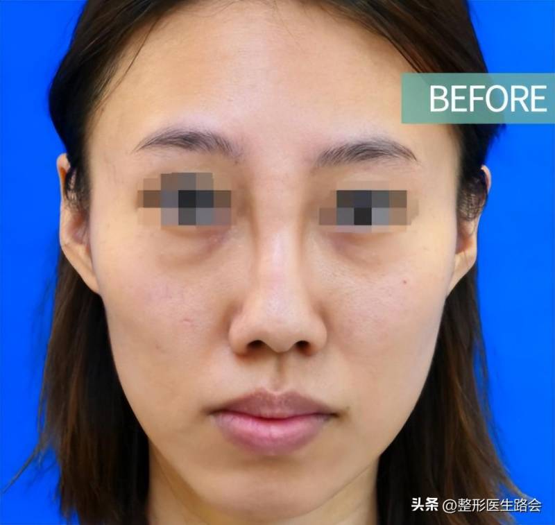北京隆鼻医生助力，29岁求美者重启鼻修复之旅，告别通天鼻
